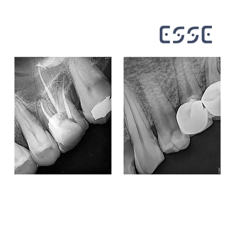 AI type Digital Sensor X-Ray HD1, HD1.5